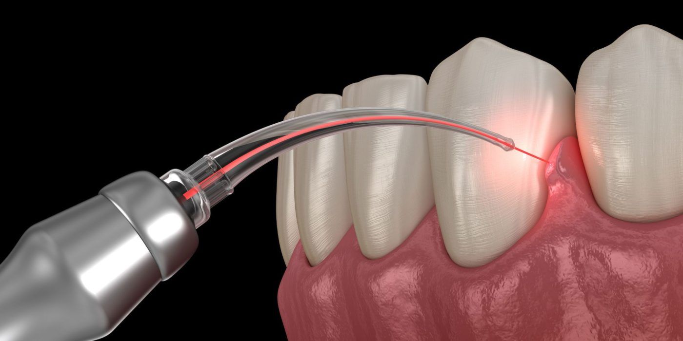 Laser Dentistry ( Using Diode Laser from Germany )