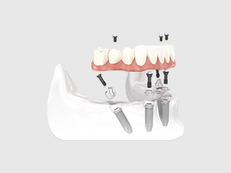 DENTAL IMPLANTS ( Master in the field of Implantology since 14 years )