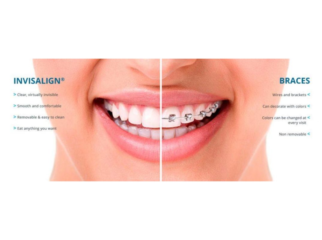 ORTHODONTIC TREATMENTS IN SURAT