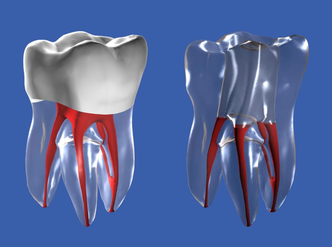 SINGLE VISIT ROOT CANAL TREATMENT (SINGLE SITTING RCT) IN SURAT