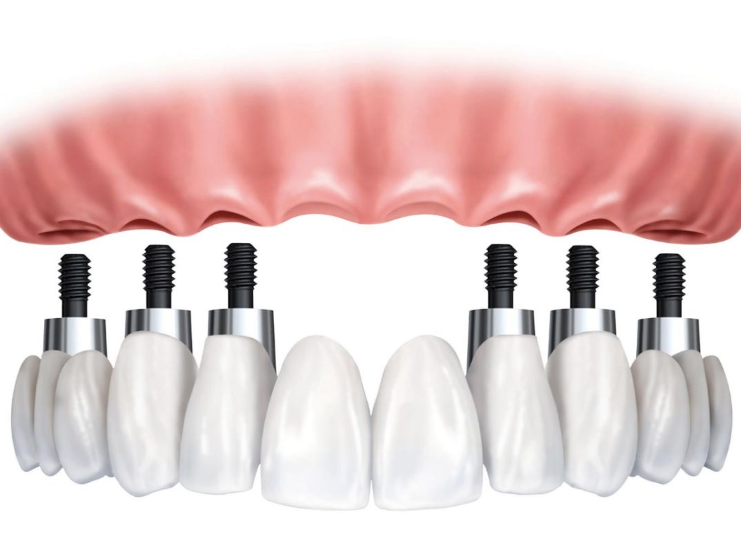 DENTAL IMPLANTS ( Master in the field of Implantology since 14 years )