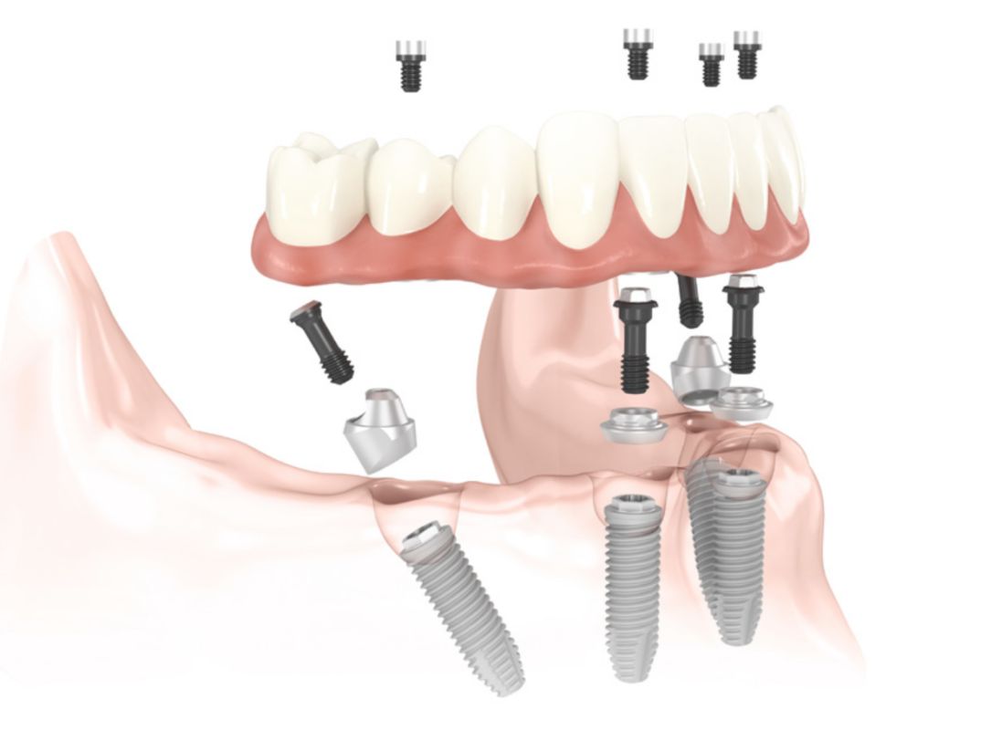 DENTAL IMPLANTS ( Master in the field of Implantology since 14 years )