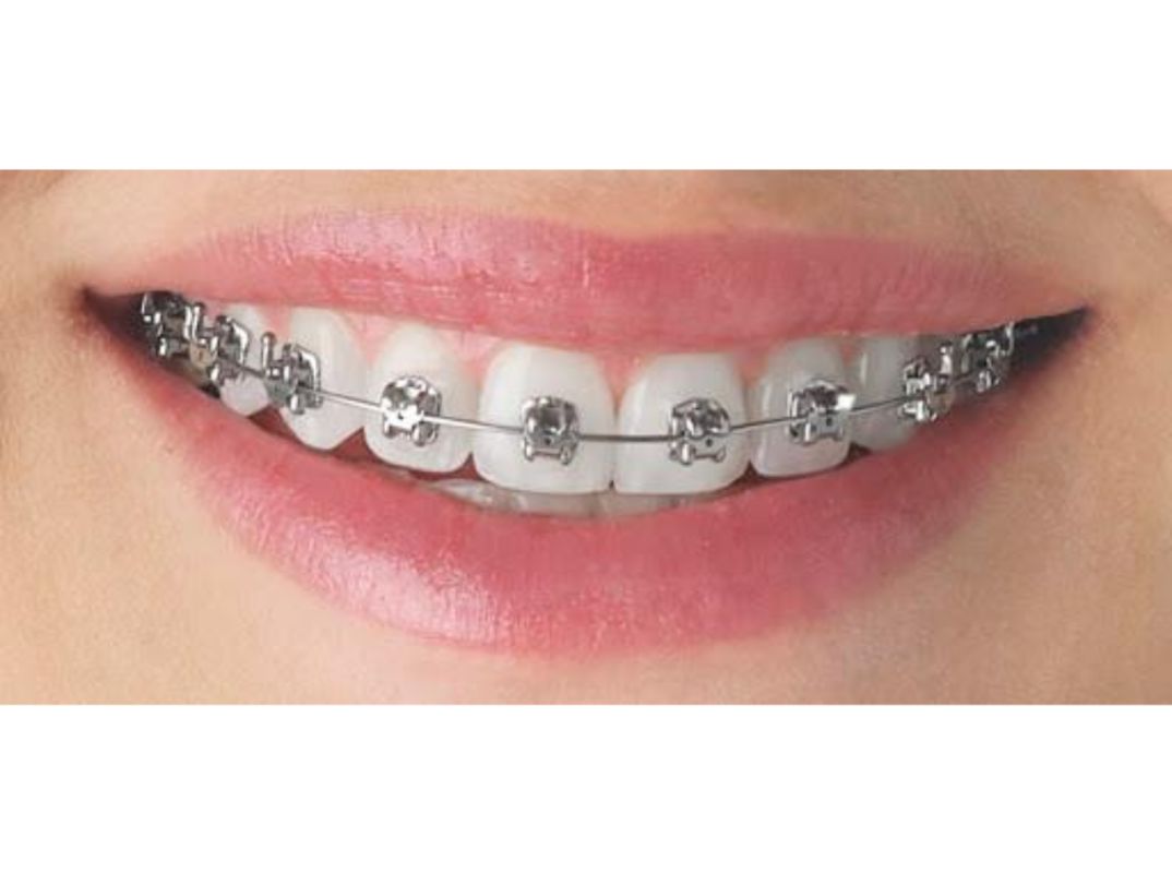 ORTHODONTIC TREATMENTS IN SURAT