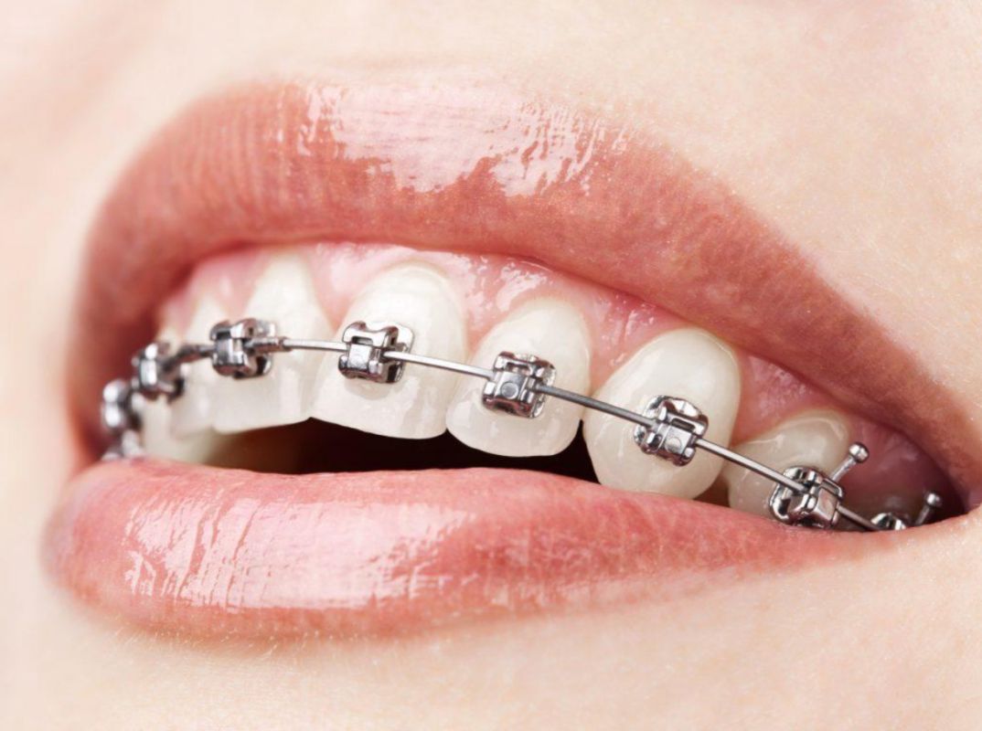 ORTHODONTIC TREATMENTS IN SURAT