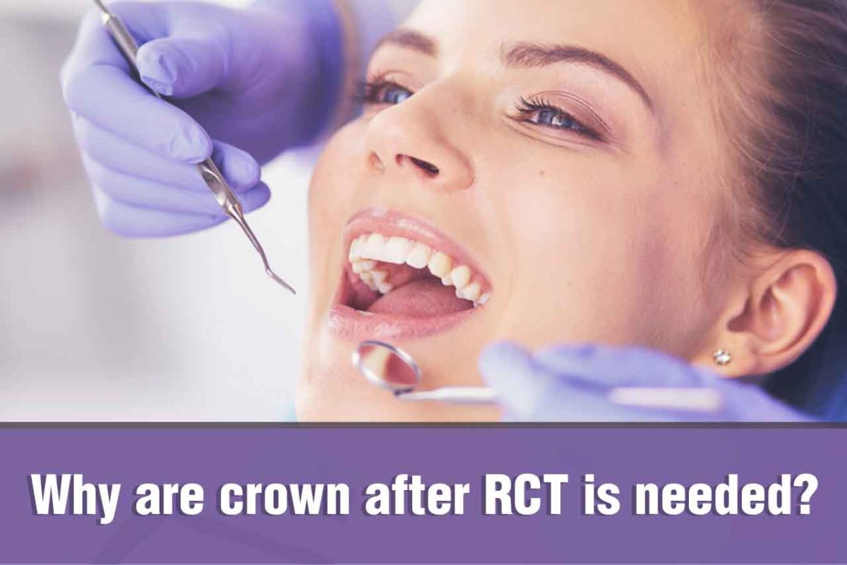 Why are crown after RCT is needed?