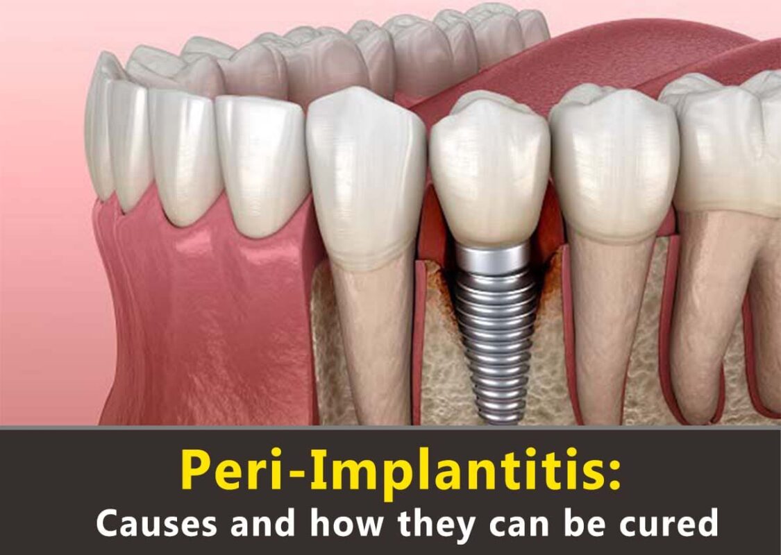 Peri-Implantitis causes and cured